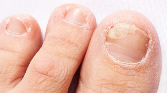 Fungal Nail Infections